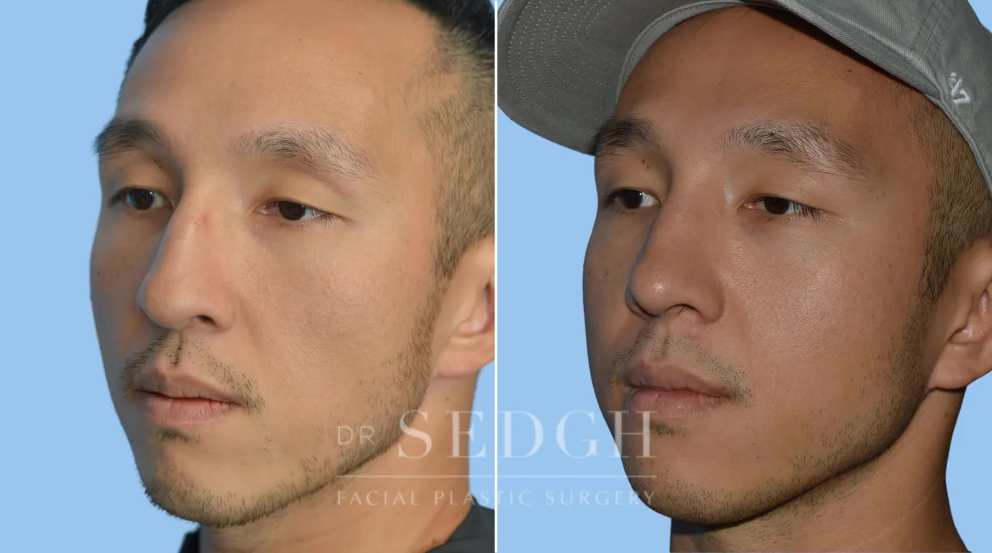 Patient 68 before Asian Rhinoplasty, view 2