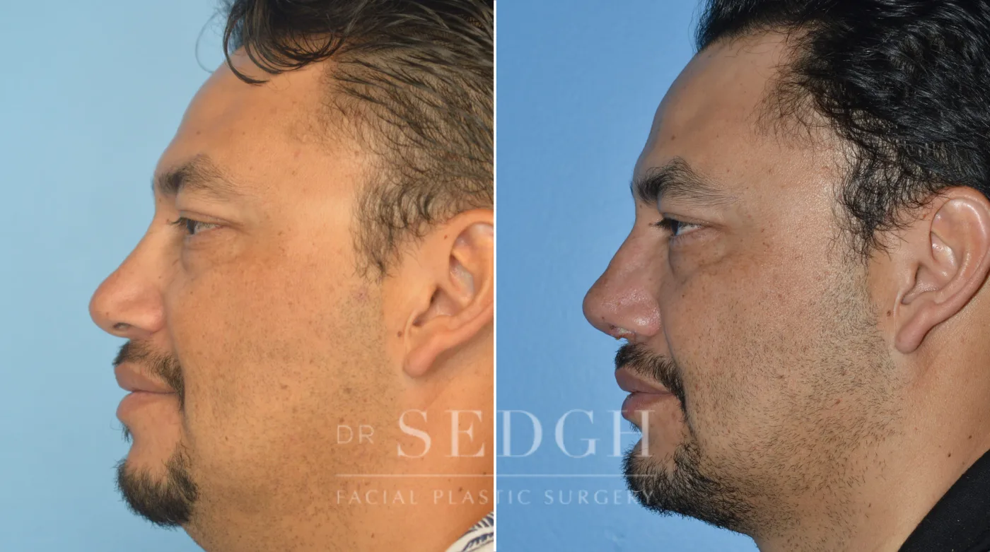 Patient 80 after Chin Augmentation, view 2