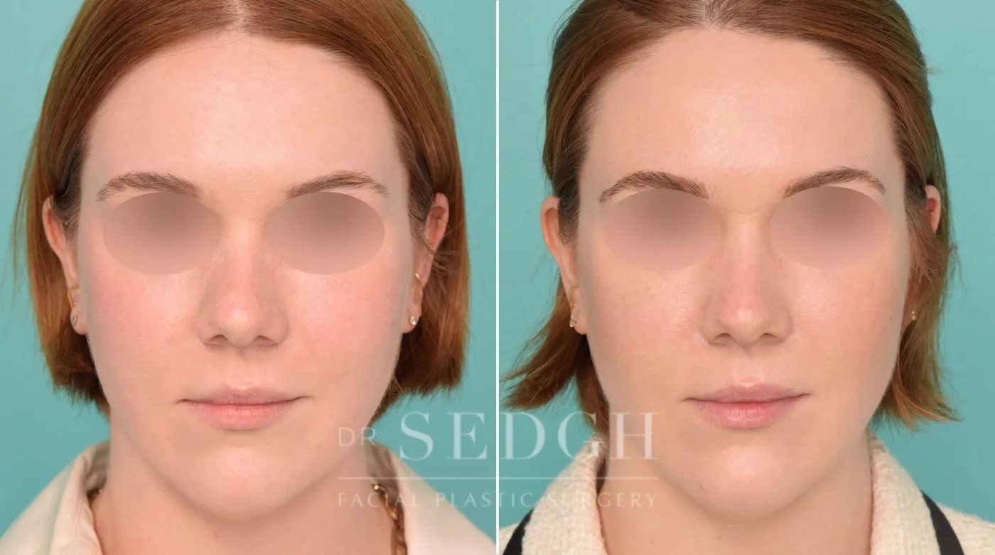 Patient 235 after Chin Filler, view 1