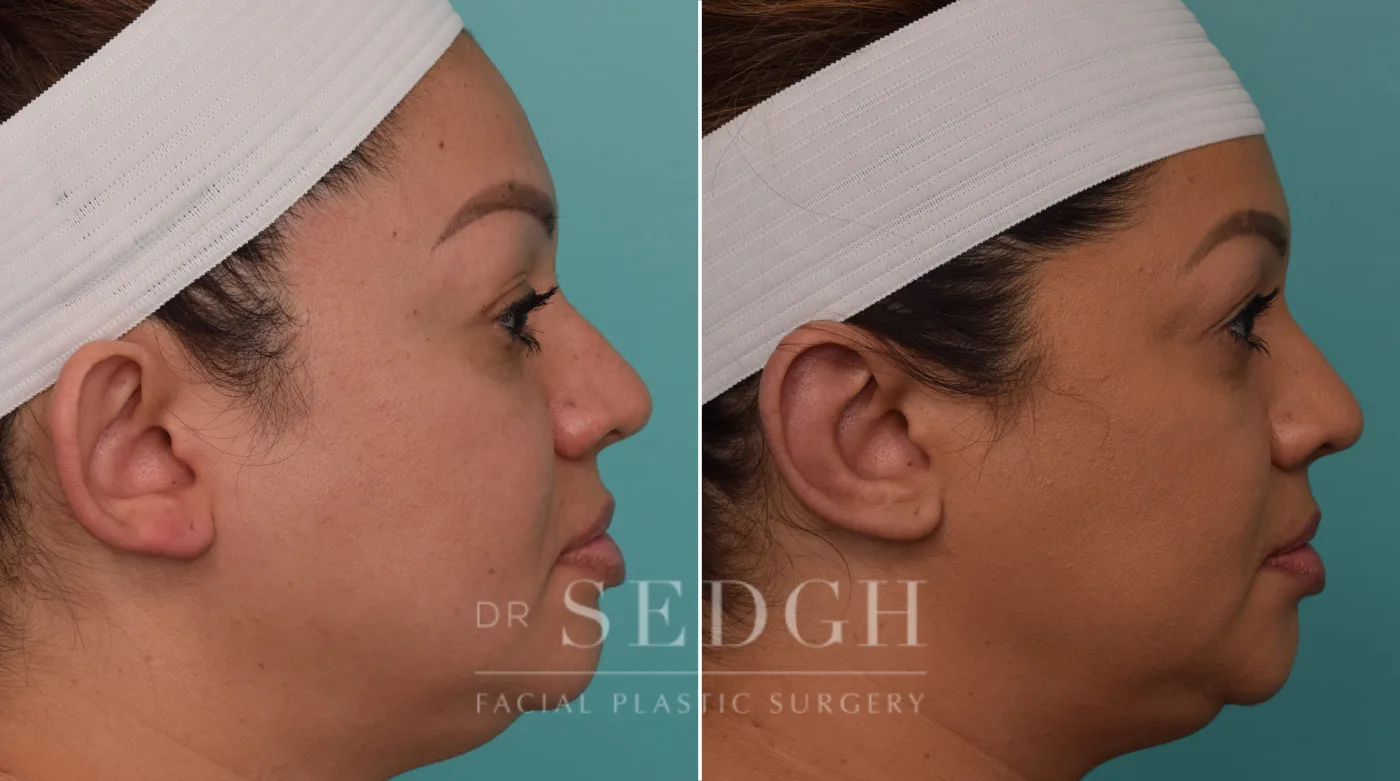 Patient 256 after Ear Pinning Surgery, view 2