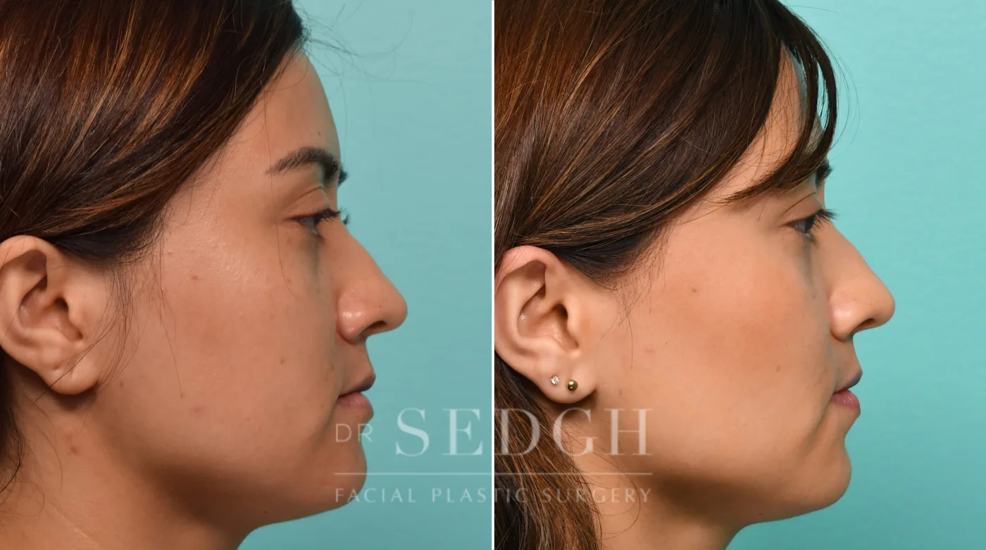 Patient 307 after Buccal Fat Reduction, view 1