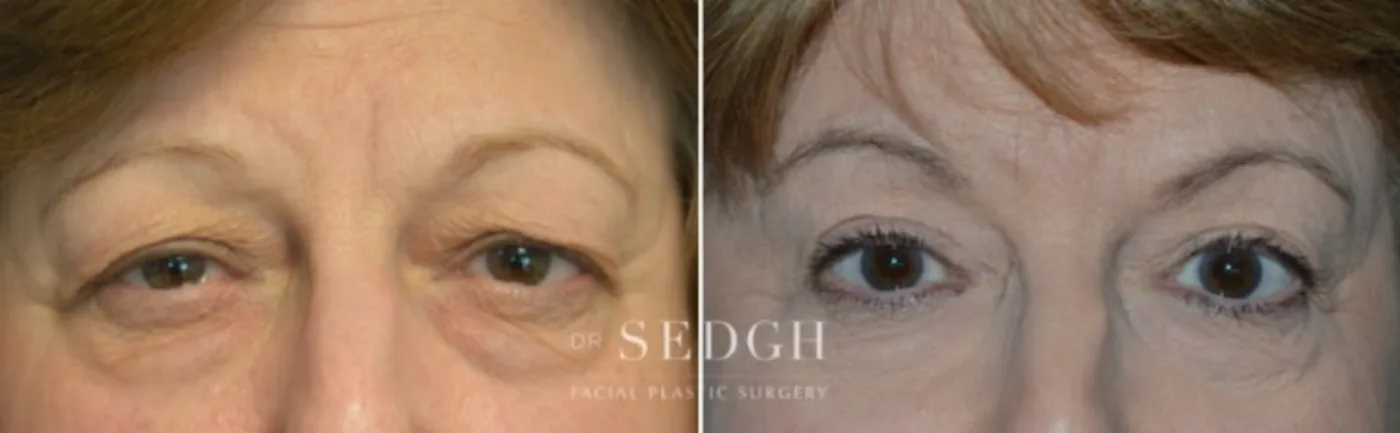 Patient 9 before Upper Blepharoplasty, view 1