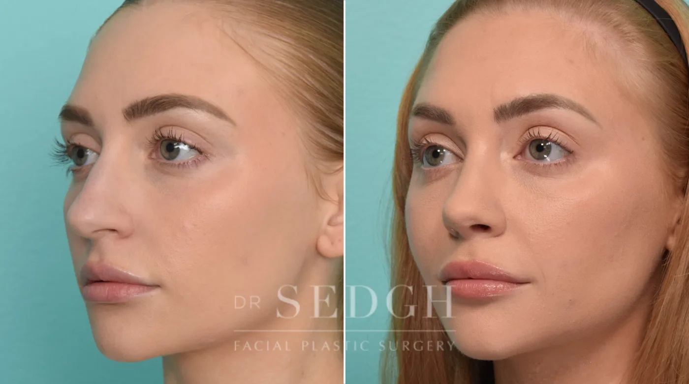 Patient 298 before Rhinoplasty, view 2