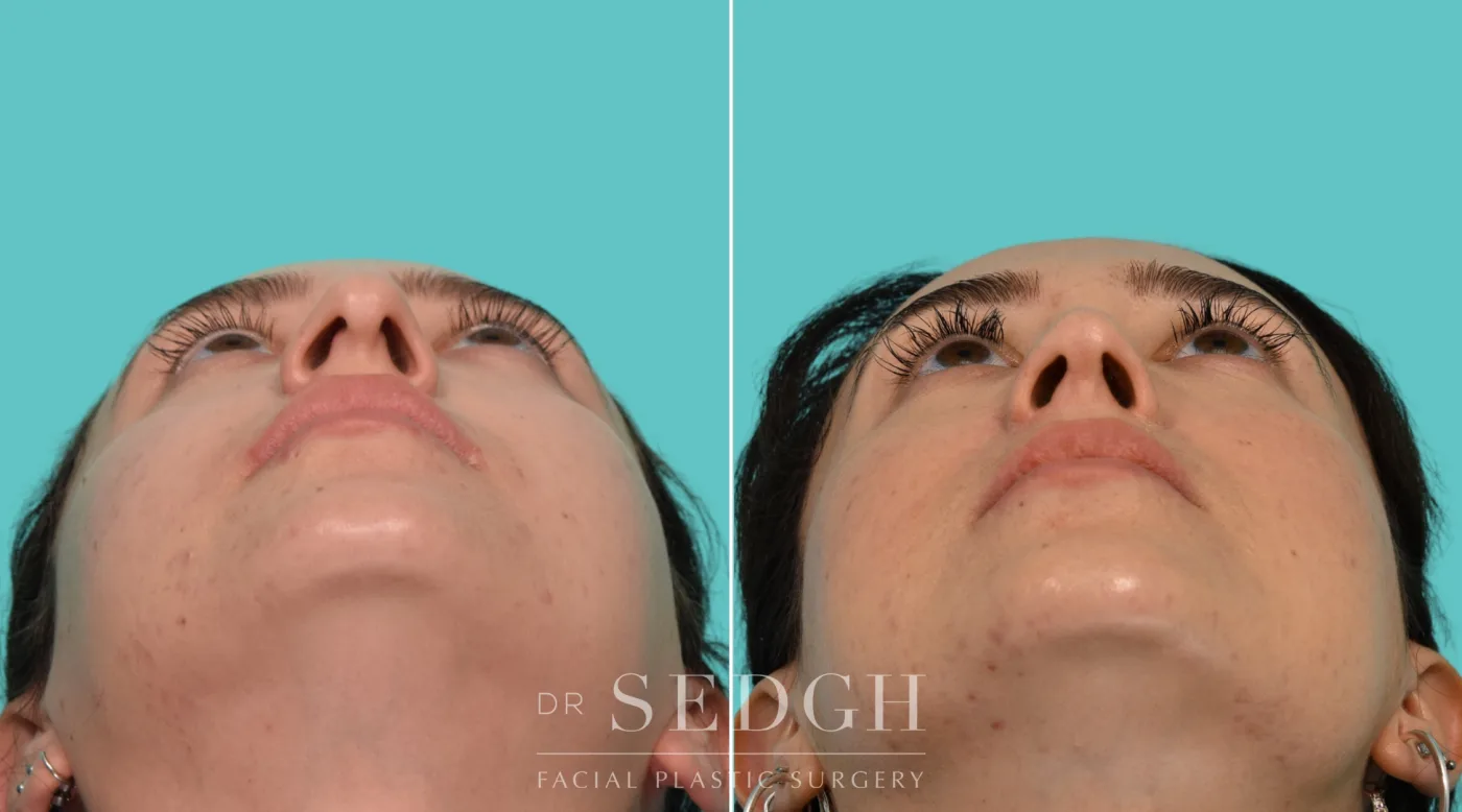 Patient 340 before Revision Rhinoplasty, view 3
