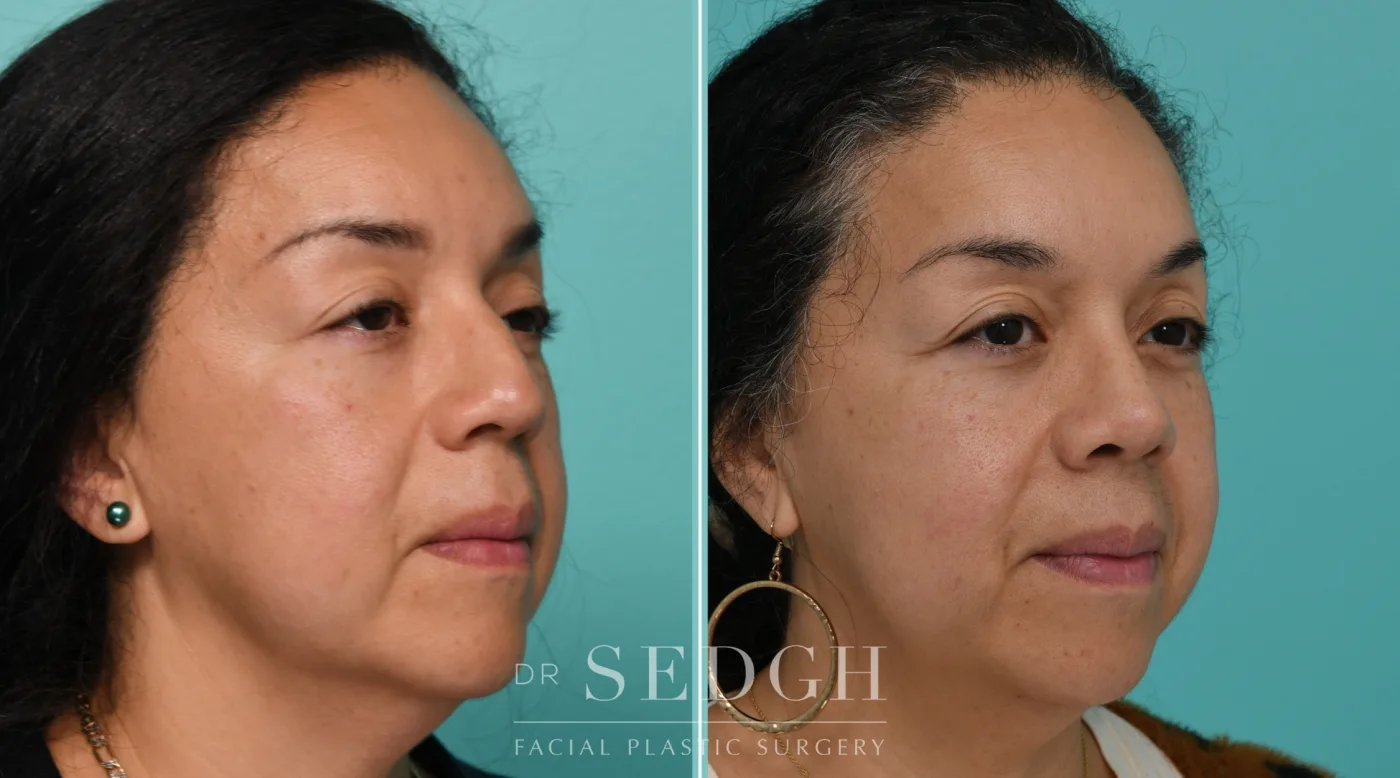 Patient 341 before Hispanic Rhinoplasty, view 2