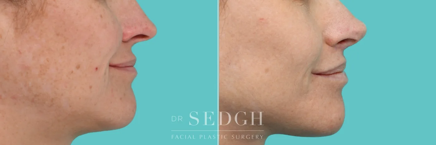 Patient 352 before Lip Lift, view 3