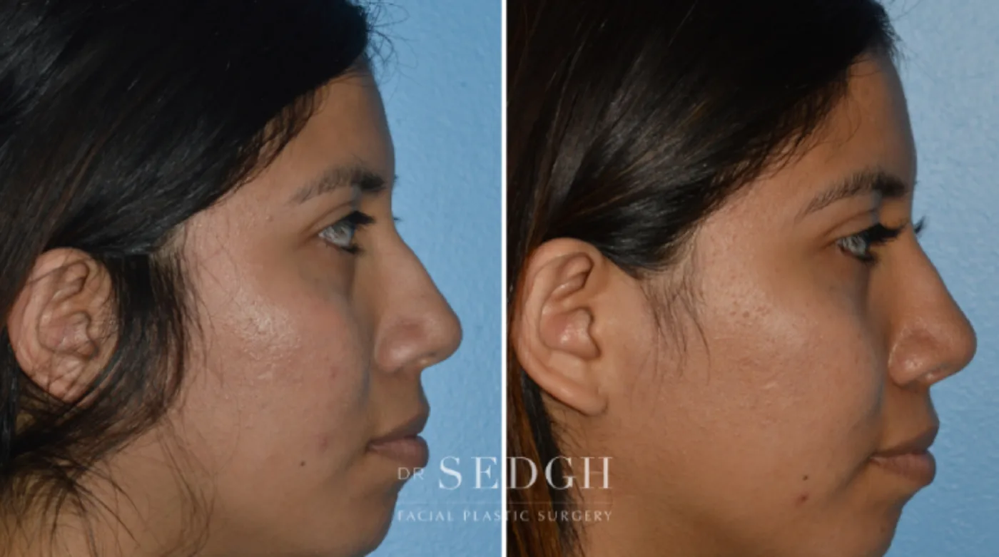 Patient 13 after Crooked Nose Surgery, view 2