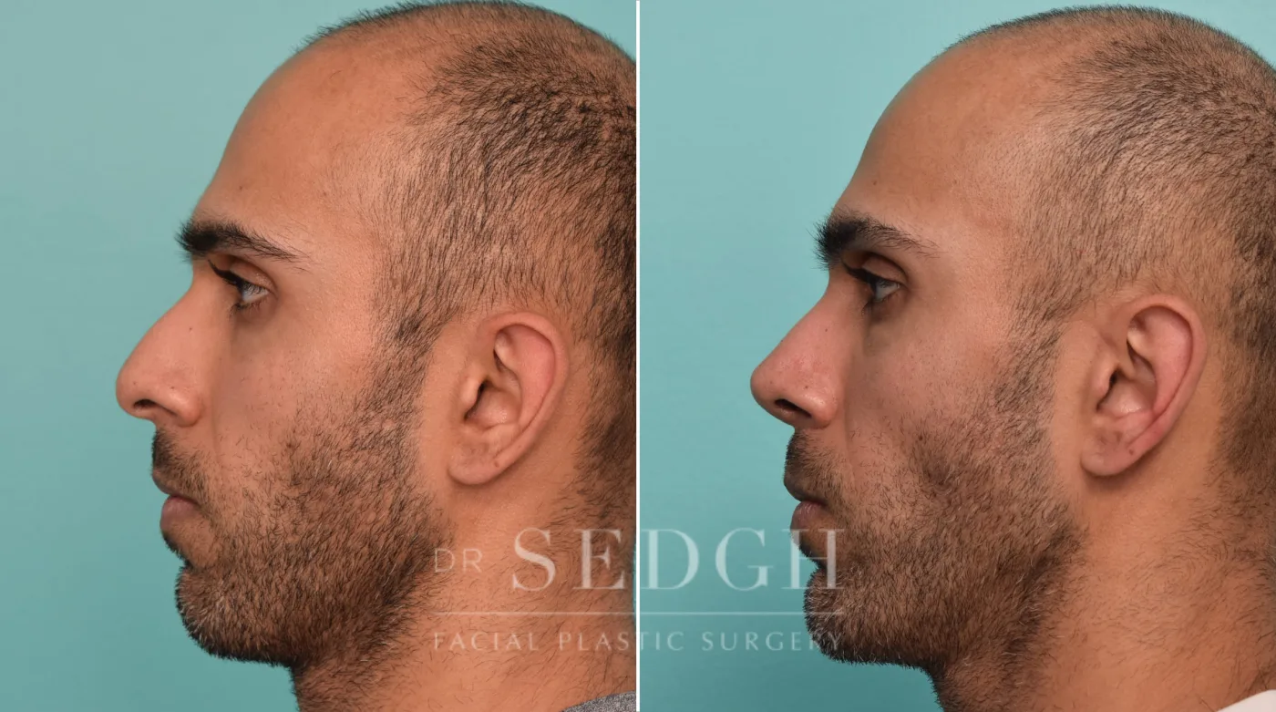 Patient 263 after Male Rhinoplasty, view 2