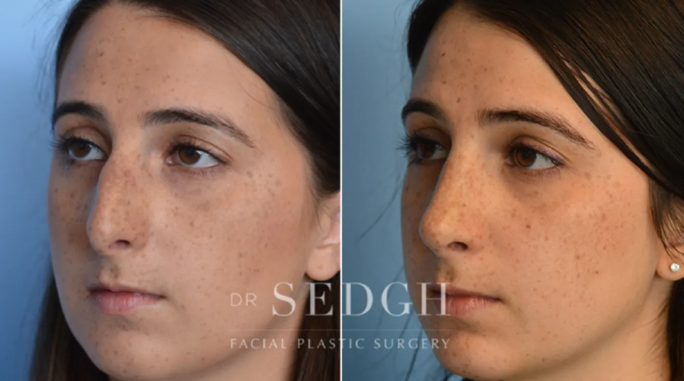 Patient 21 before Hispanic Rhinoplasty, view 1
