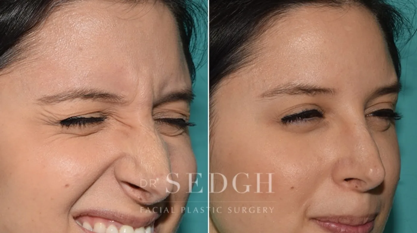 Patient 1 after Wrinkle Relaxers, view 1