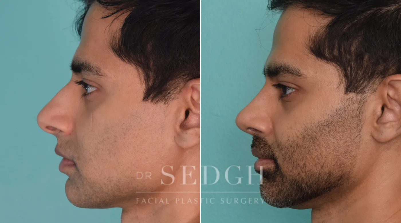Patient 210 after Middle Eastern Rhinoplasty, view 2