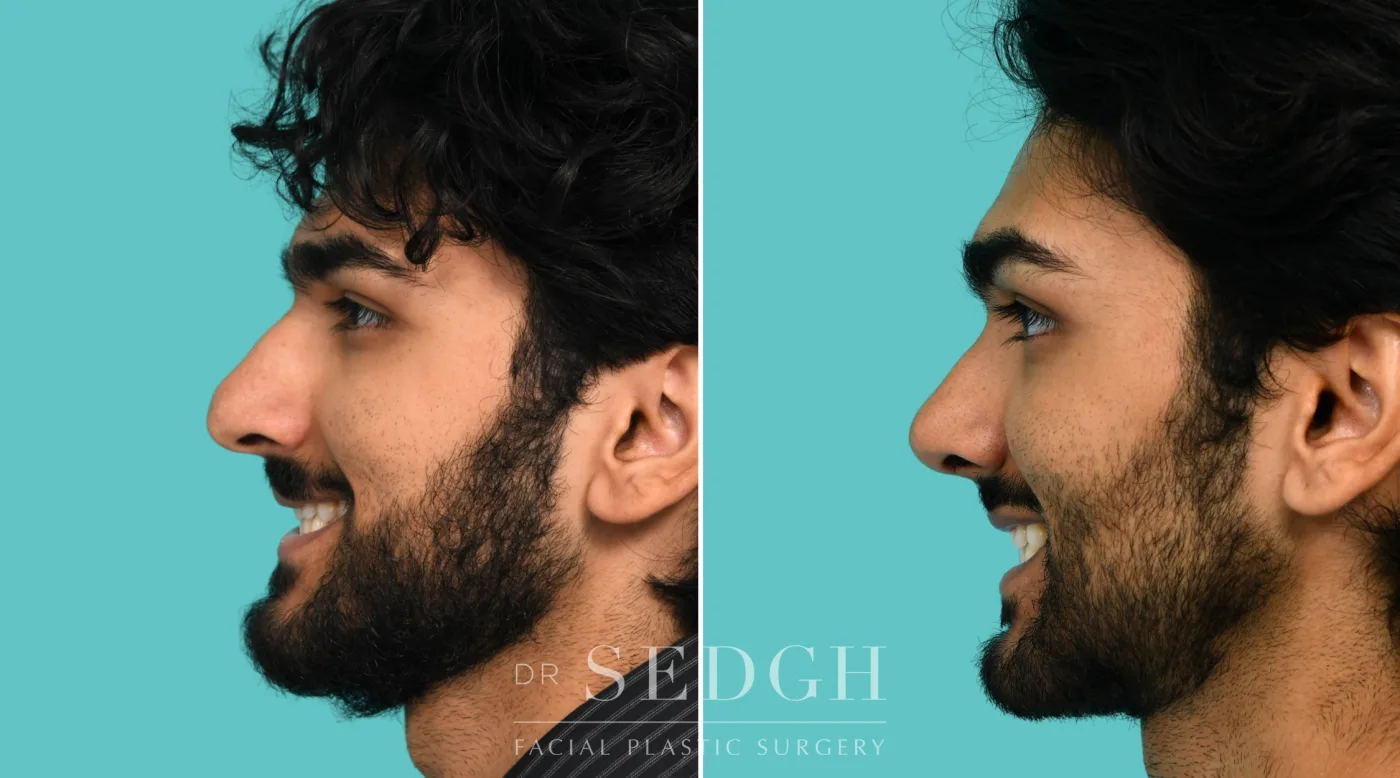 Patient 364 before Male Rhinoplasty, view 4