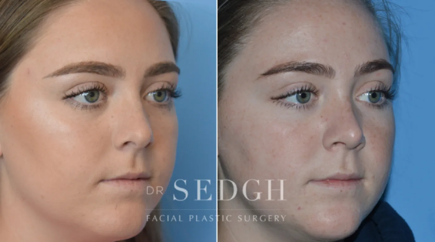 Patient 14 before Crooked Nose Surgery, view 1
