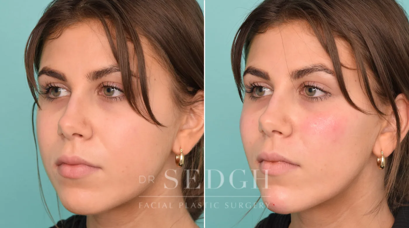 Patient 233 before Chin Filler, view 1