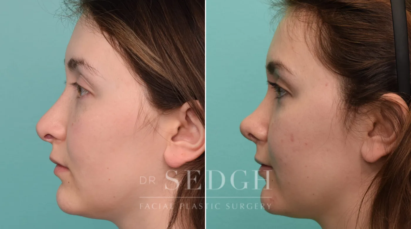 Patient 328 after Revision Rhinoplasty, view 2