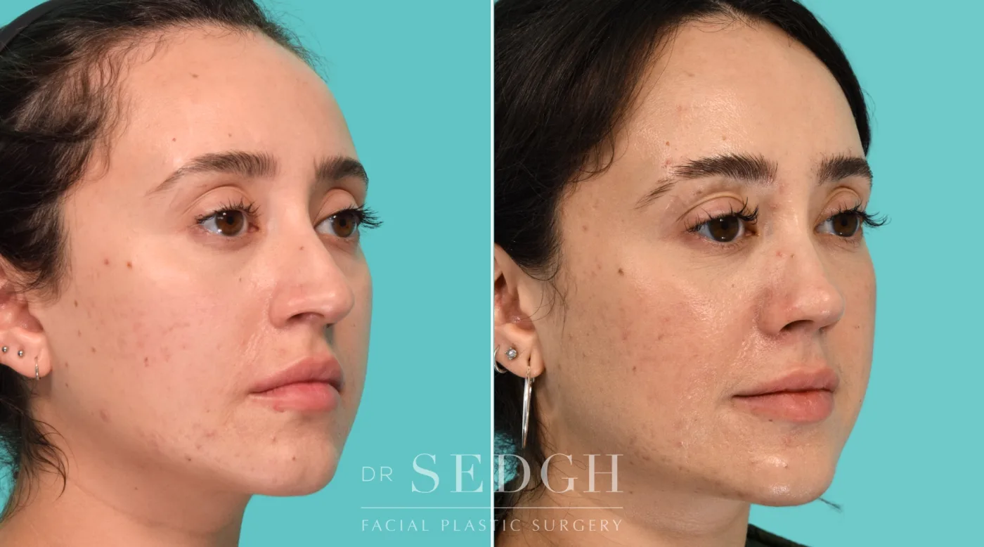 Patient 340 before Revision Rhinoplasty, view 2