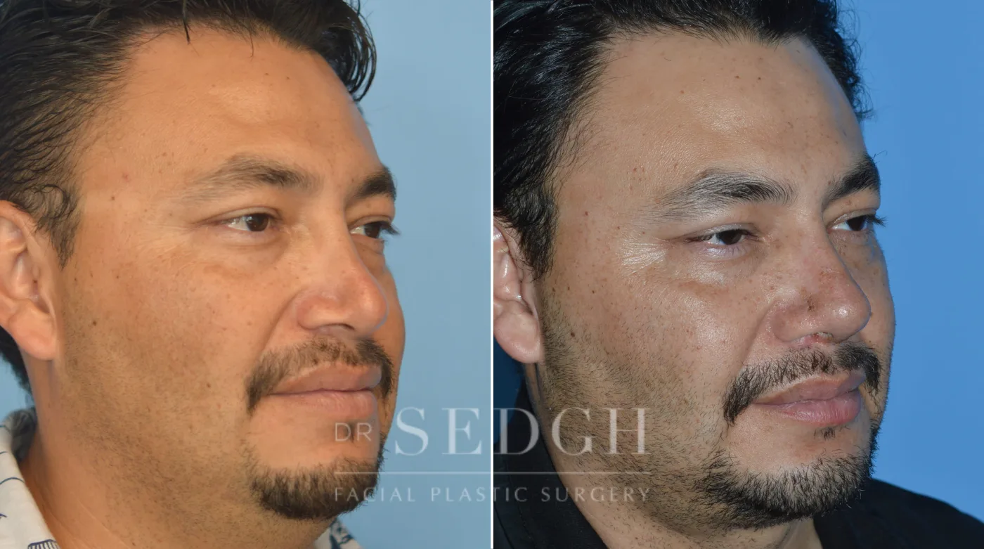 Patient 80 before Chin Augmentation, view 1
