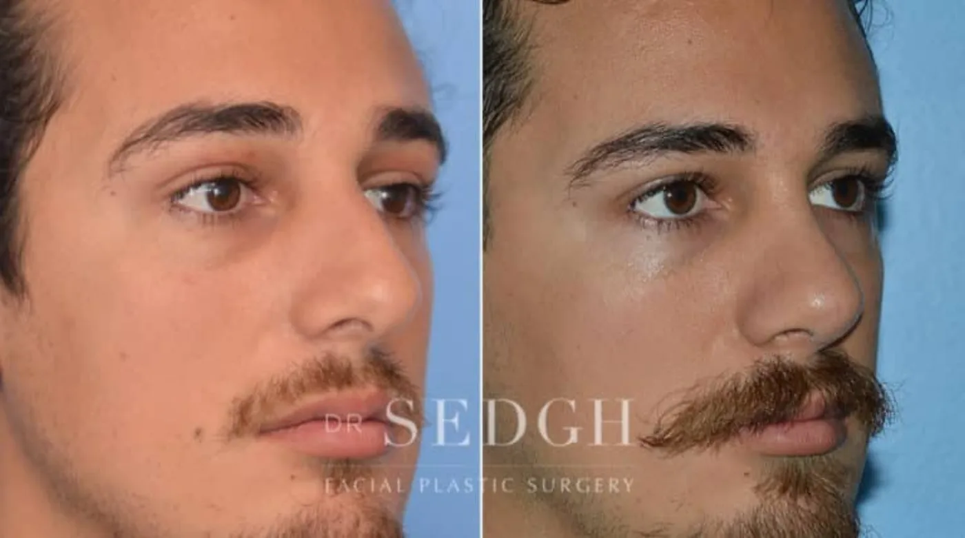 Patient 5 after Hispanic Rhinoplasty, view 1