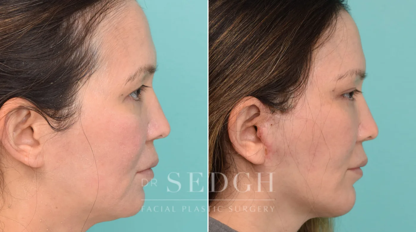Patient 295 after Face Lift, view 1