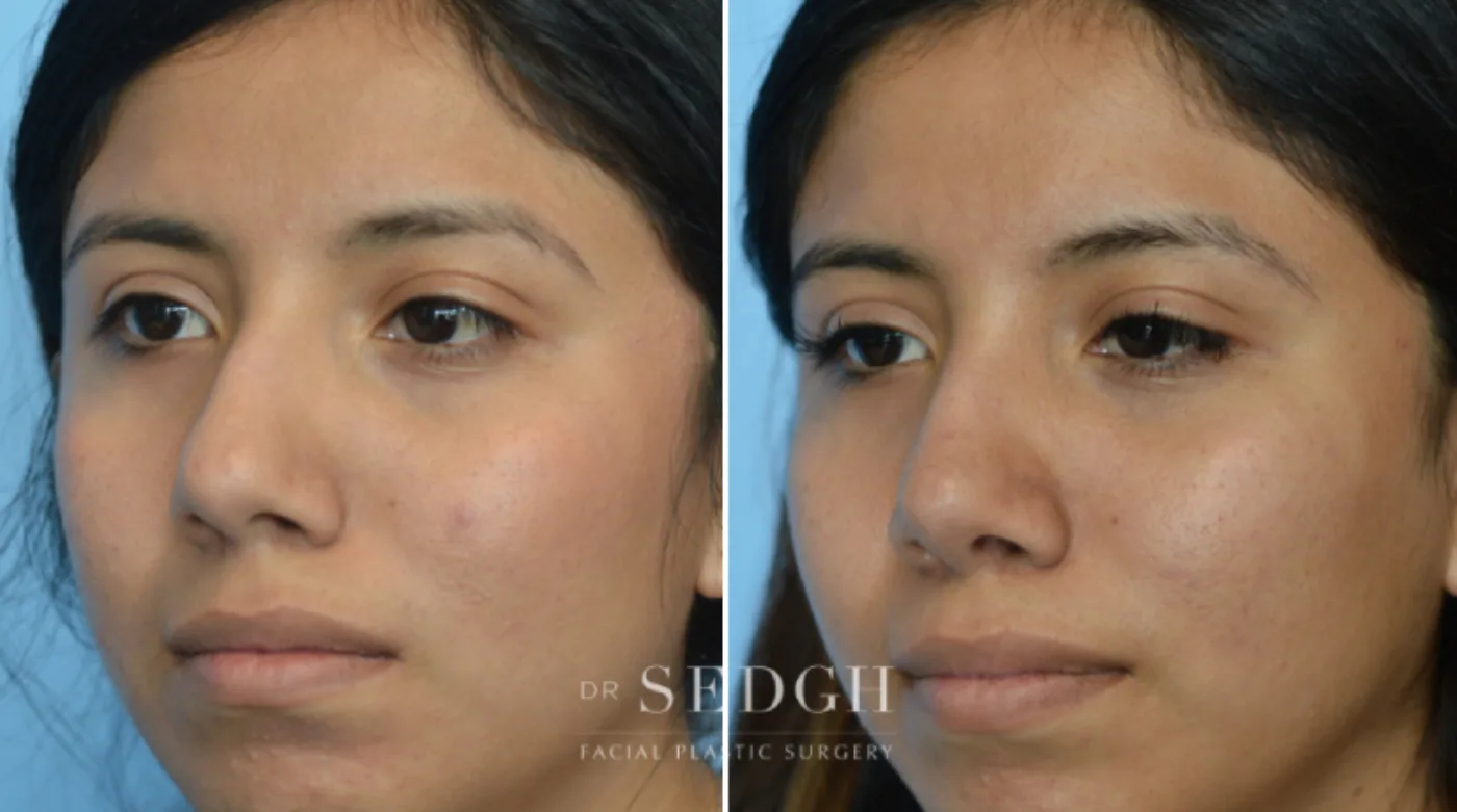 Patient 13 before Crooked Nose Surgery, view 1