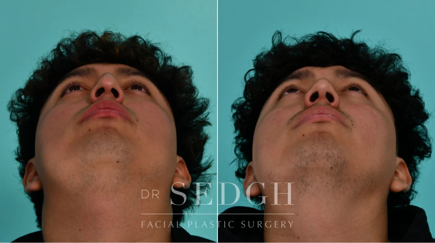 Patient 339 after Male Rhinoplasty, view 3
