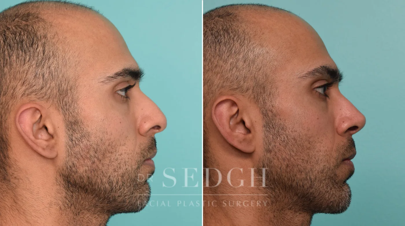 Patient 263 after Male Rhinoplasty, view 1