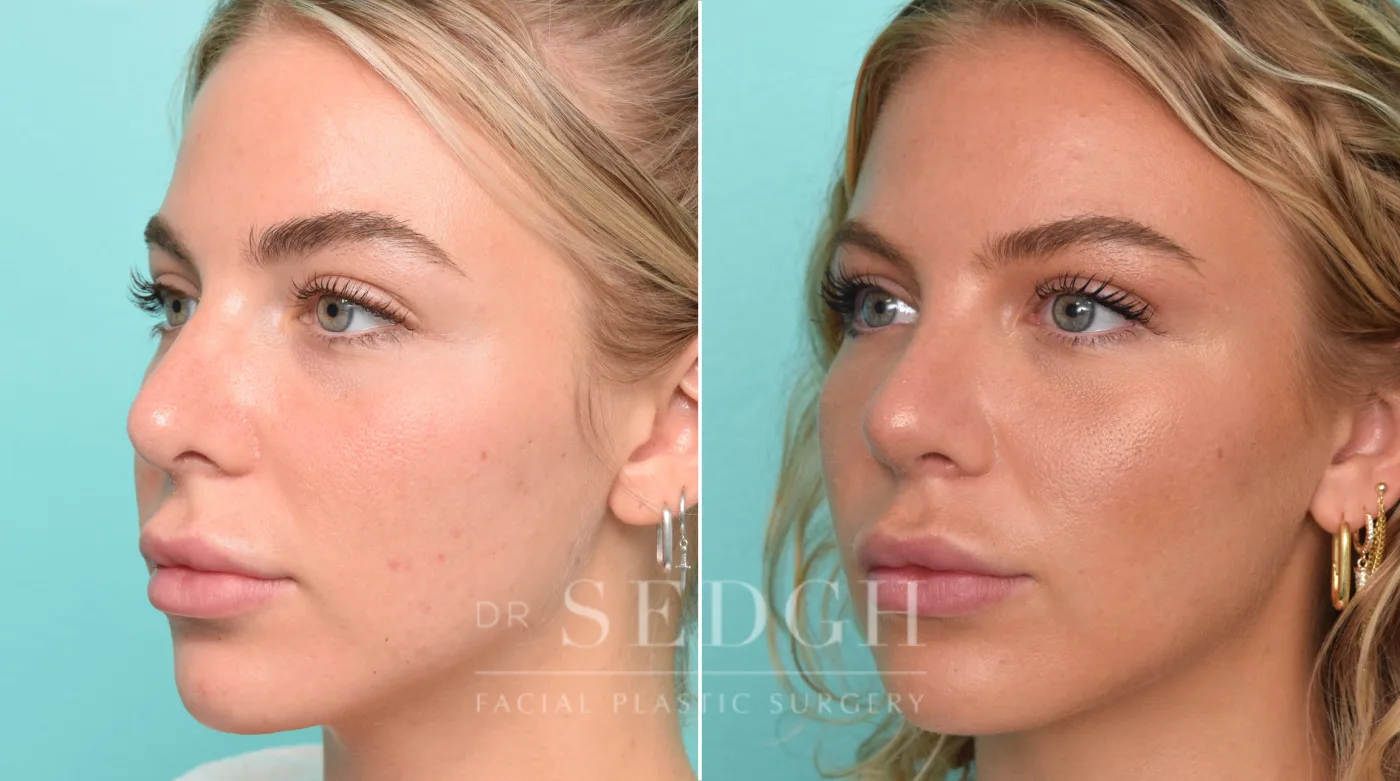 Patient 299 before Revision Rhinoplasty, view 2