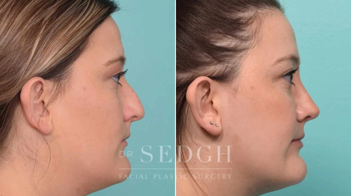 Patient 303 after Rhinoplasty, view 1