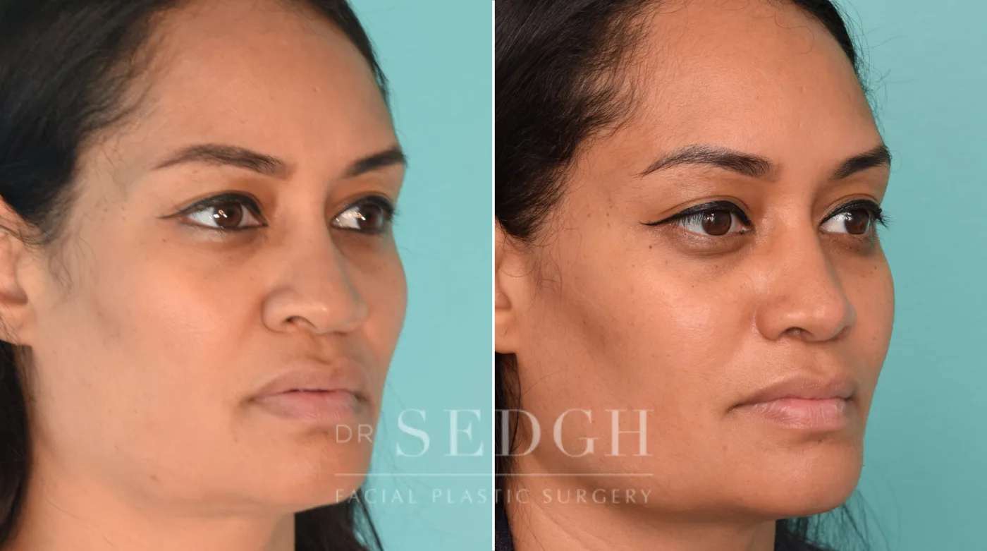 Patient 229 before Female Rhinoplasty, view 2
