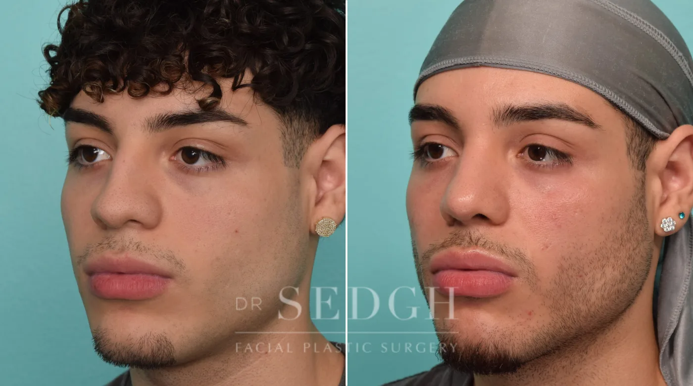 Patient 289 before Rhinoplasty, view 1