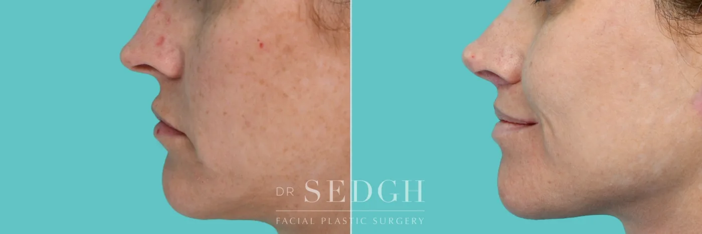Patient 352 after Lip Lift, view 3