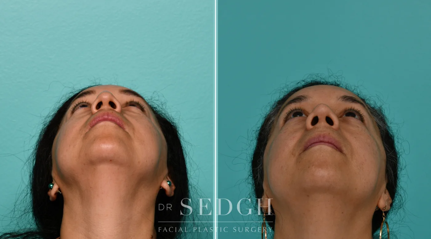 Patient 341 before Hispanic Rhinoplasty, view 3
