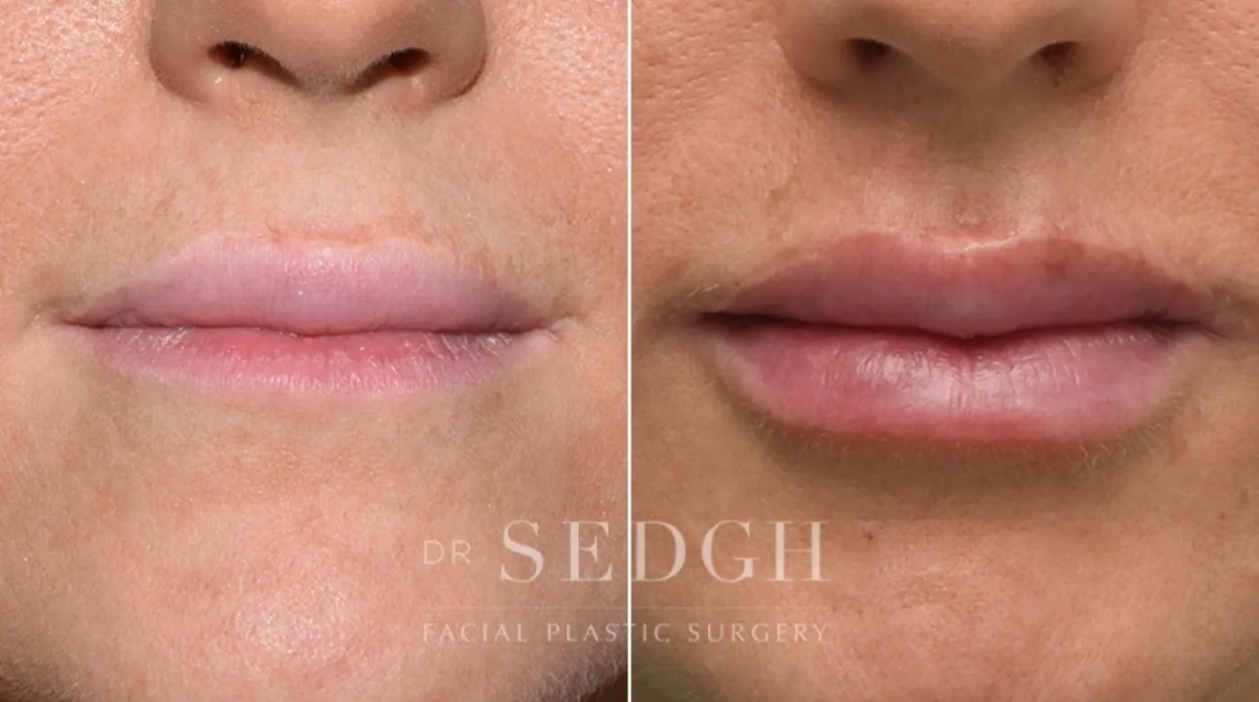 Patient 1 before lip augmentation, view 1