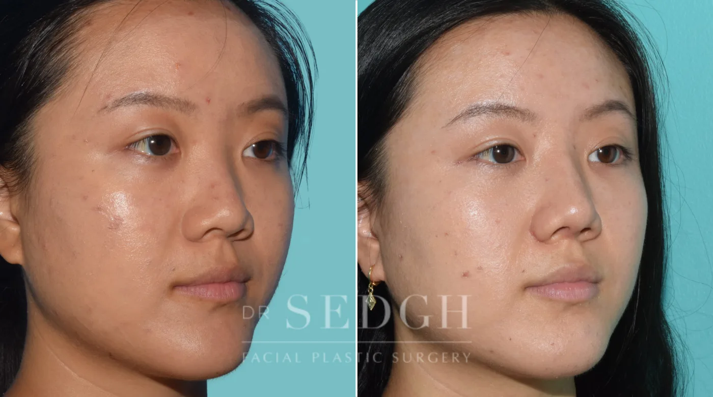Patient 36 before Middle Eastern Rhinoplasty, view 1