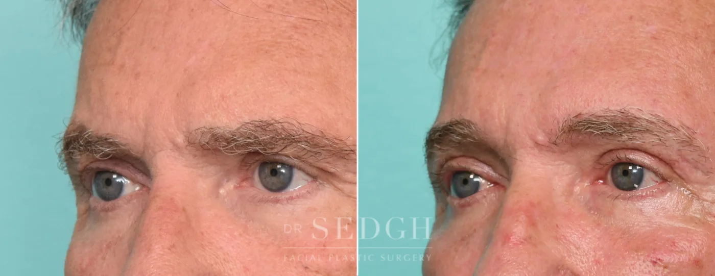 Patient 315 before Upper Blepharoplasty, view 1