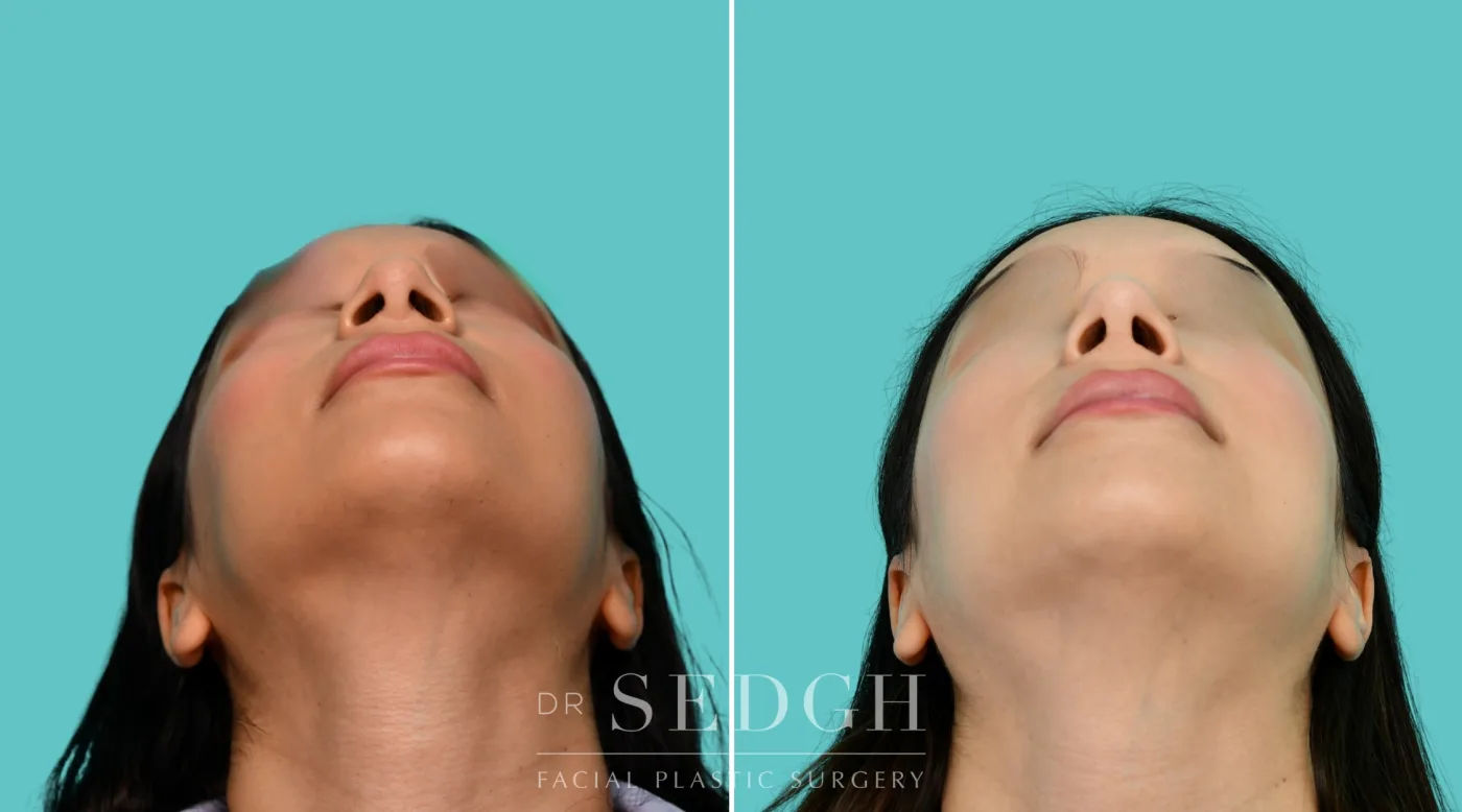 Patient 354 after Revision Rhinoplasty, view 4