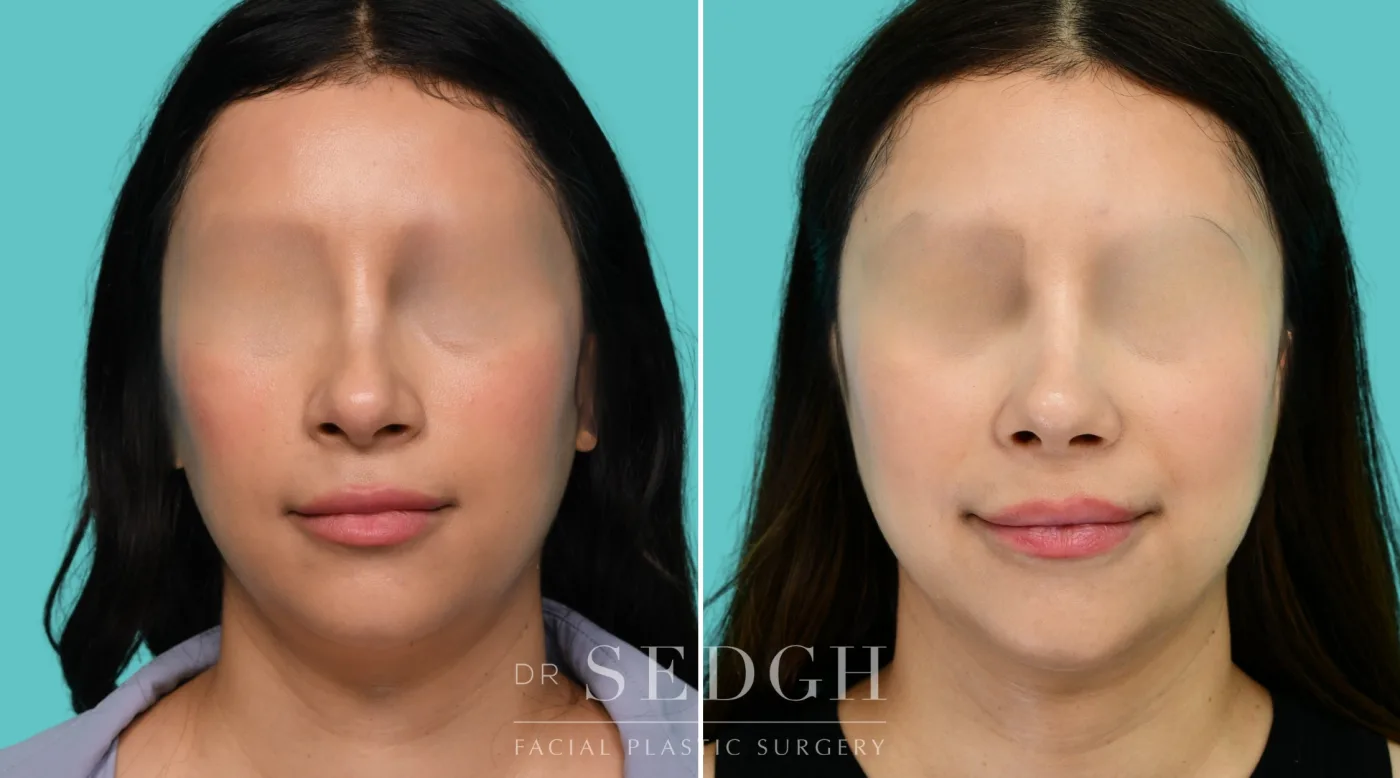 Patient 354 before Revision Rhinoplasty, view 1