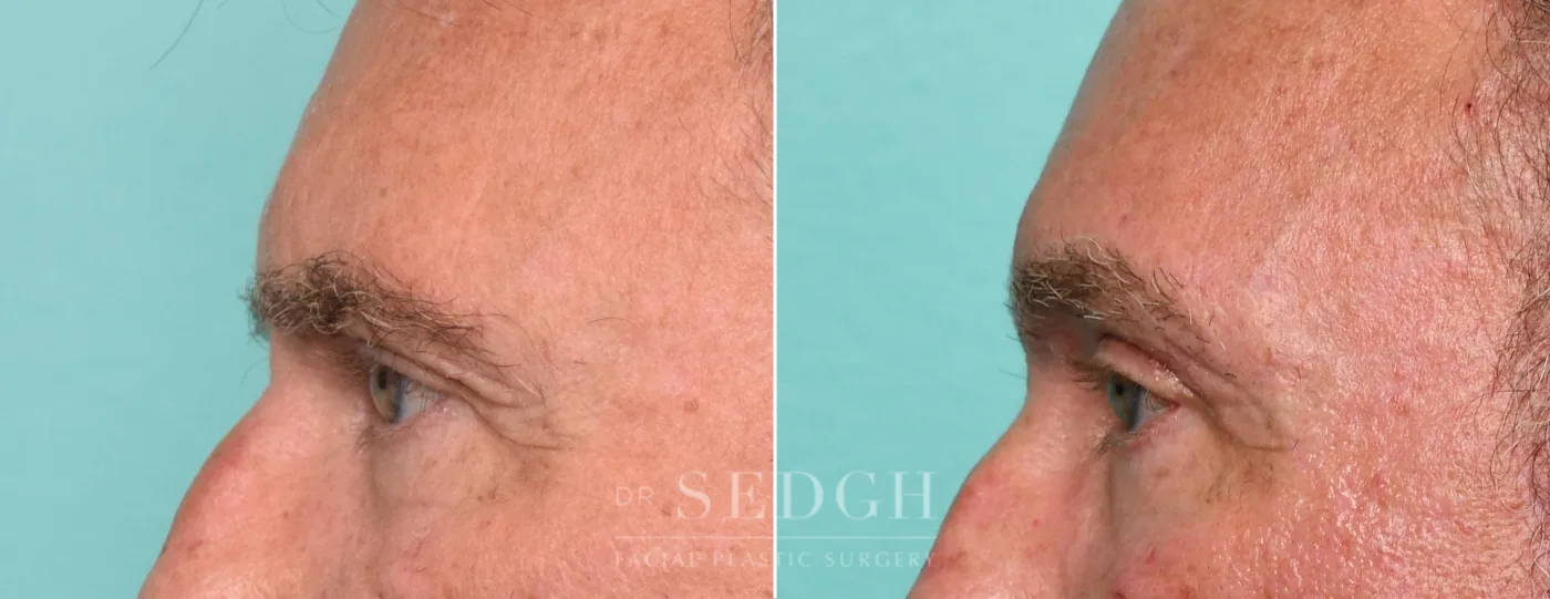 Patient 315 after Upper Blepharoplasty, view 1
