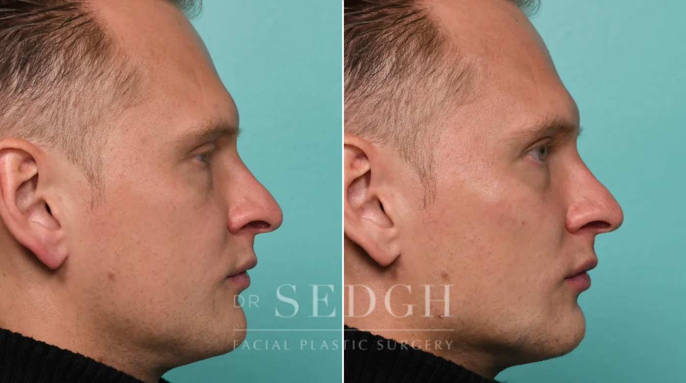 Patient 318 after Chin Filler, view 1