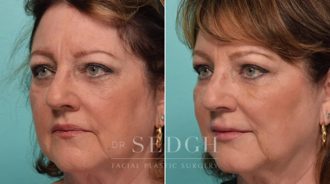 Patient 304 after Wrinkle Relaxers, view 1