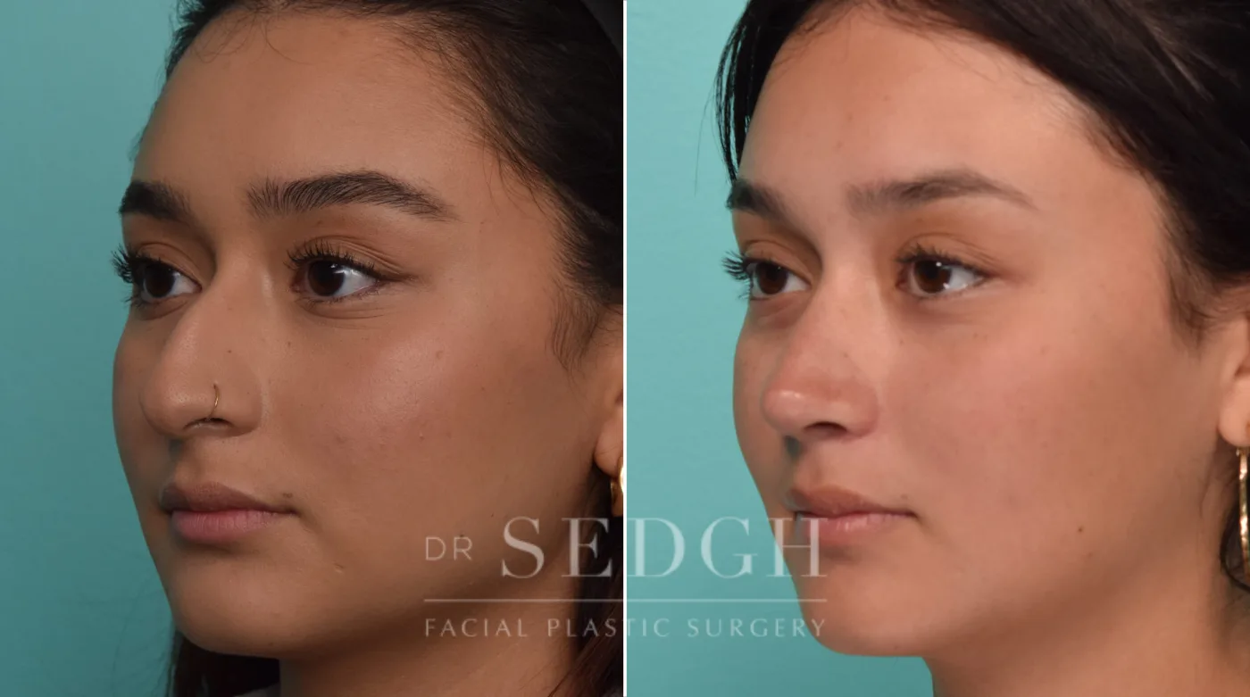 Patient 287 before Female Rhinoplasty, view 1
