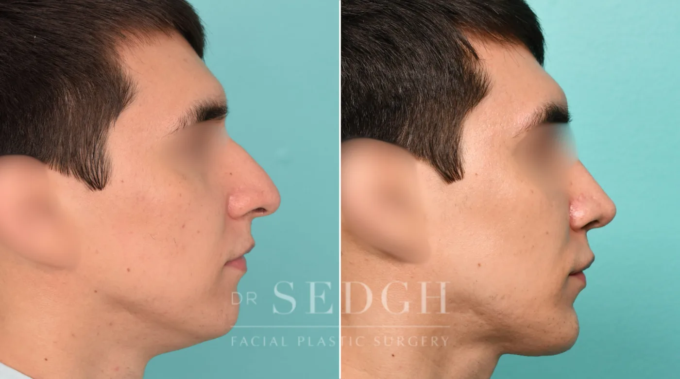Patient 317 after Neck Liposuction, view 1