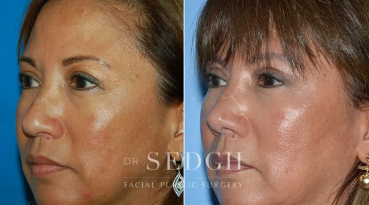 Patient 6 before Hispanic Rhinoplasty, view 1