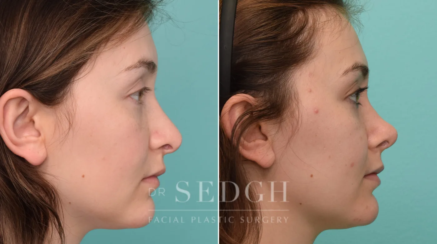 Patient 328 after Revision Rhinoplasty, view 1