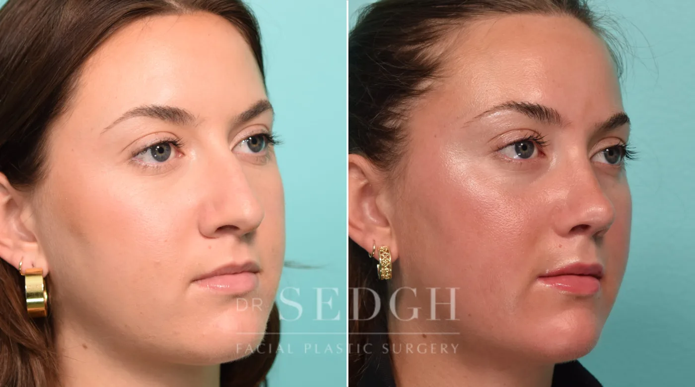 Patient 297 before Rhinoplasty, view 1