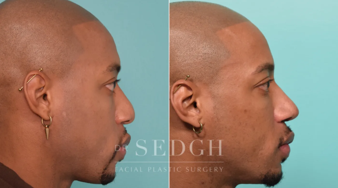 Patient 266 after African American Rhinoplasty, view 2