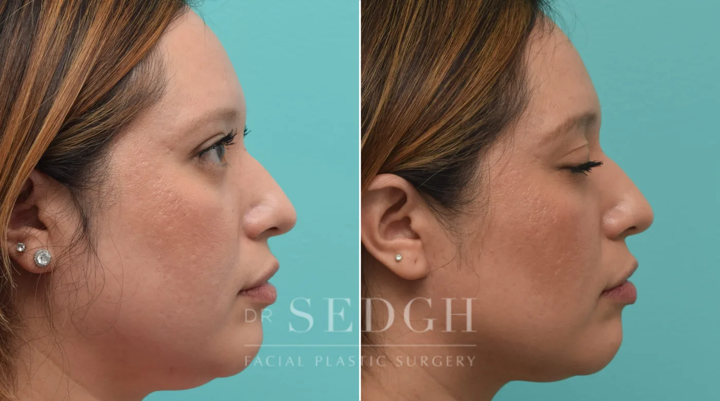 Patient 240 after Buccal Fat Reduction, view 1