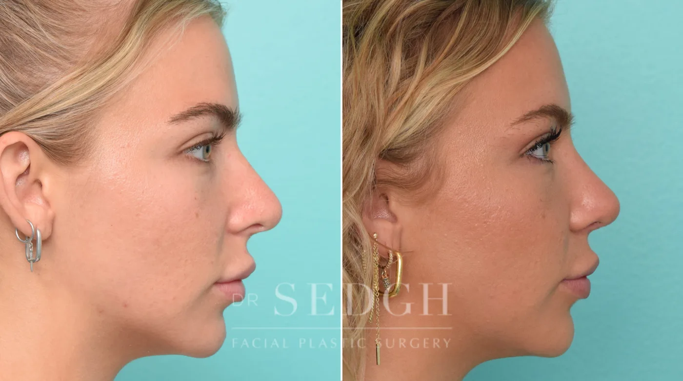 Patient 299 after Revision Rhinoplasty, view 1