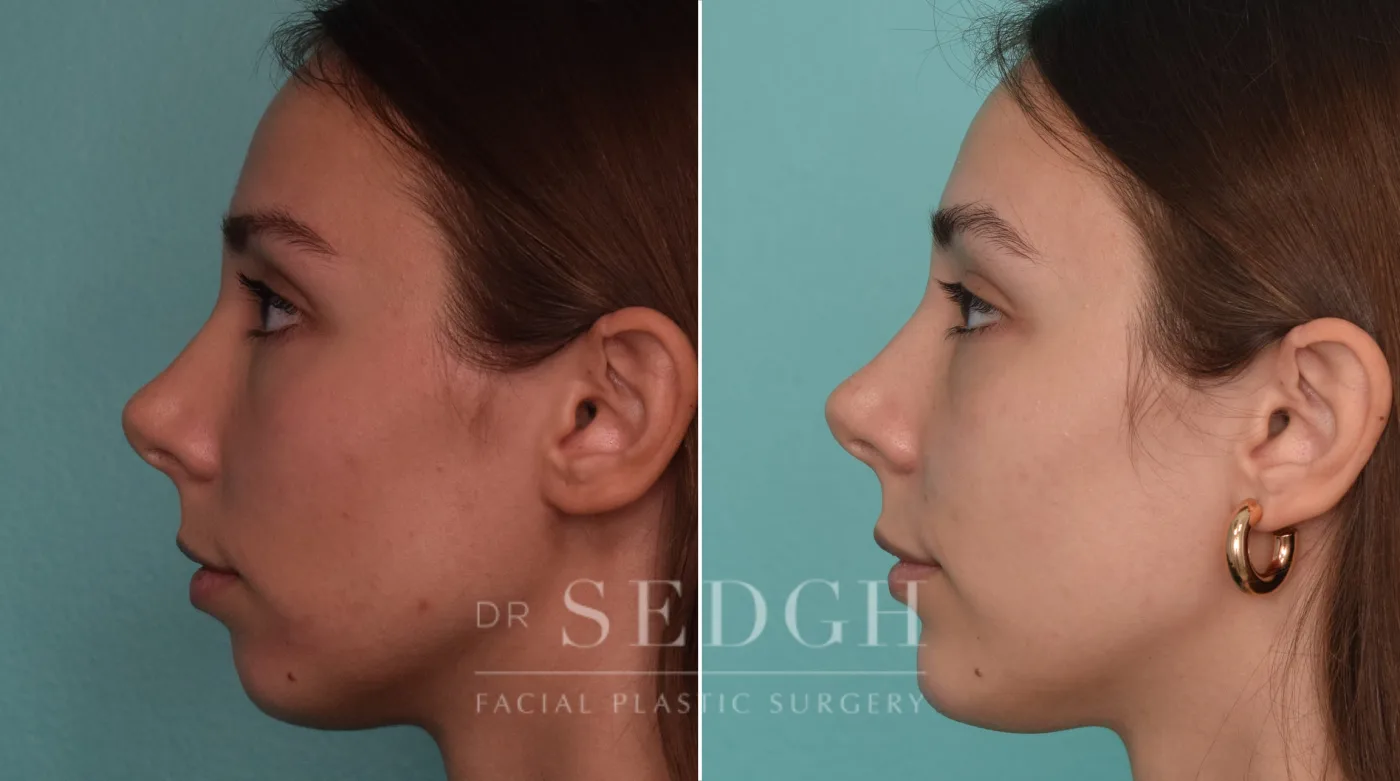Patient 232 after Chin Filler, view 1
