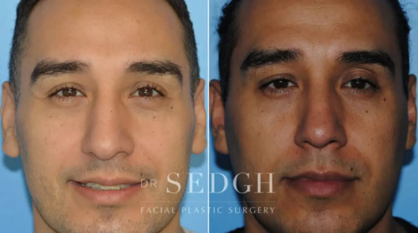 Patient 10 before Hispanic Rhinoplasty, view 1